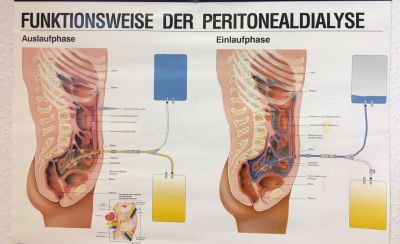 Schaubild der Funktionsweise der Peritonealdialyse 